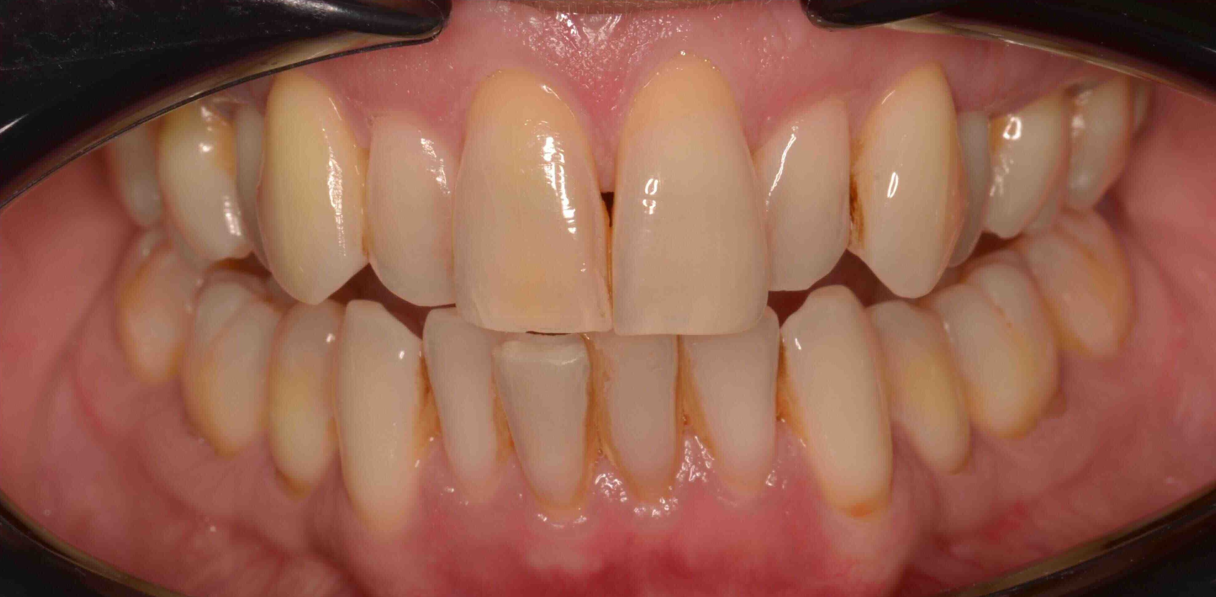 Invisalign and whitening transformation